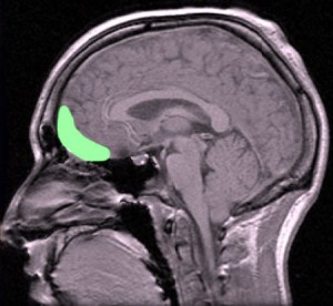 Idle mind. Patients with obsessive-compulsive disorder and their relatives show reduced activity in the orbitofrontal cortex region (green) of the brain. Credit: Paul Wicks, Kings College