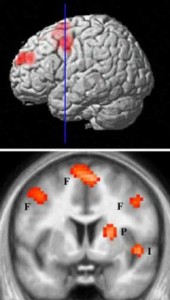 The "hate circuit" of the brain – areas that activate when looking at a hated person – revealed by fMRI scans. F = frontal cortex; P = putamen; I = insular <br>(Credit: UCL)