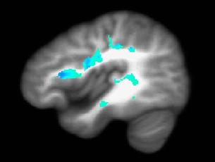 Yellow areas in the brain of a heavy marijuana user show brain regions with the most significant abnormalities. These areas correspond with those under development during normal adolescent years.