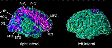 (At left): this MRI image depicts where a person at high risk for depression has lost a significant portion of brain tissue in the right lateral cortex of the brain’s right hemisphere (color-coded with purple and blue colors indicating loss of brain tissue), compared to the MRI image (at right) of the left lateral brain which shows no loss of brain matter. Average loss of brain tissue among people at high risk for depression was 30 percent.