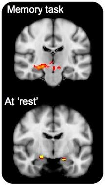 Brain maps show increased brain activity for carriers of the gene variant relative to non-carriers while at 'rest' and while conducting a memory-related task.