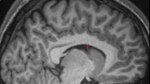 the paracingulate sulcus (or PCS)